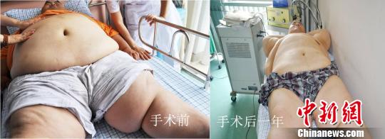 “中国第一胖”男子就医 一年减肥81公斤(组图)