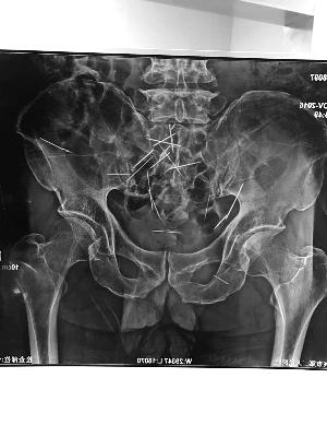 老人腹中现22根绣花针或已存几十年 家人报警