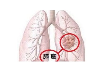 北京市新发恶性肿瘤中肺癌约占20%