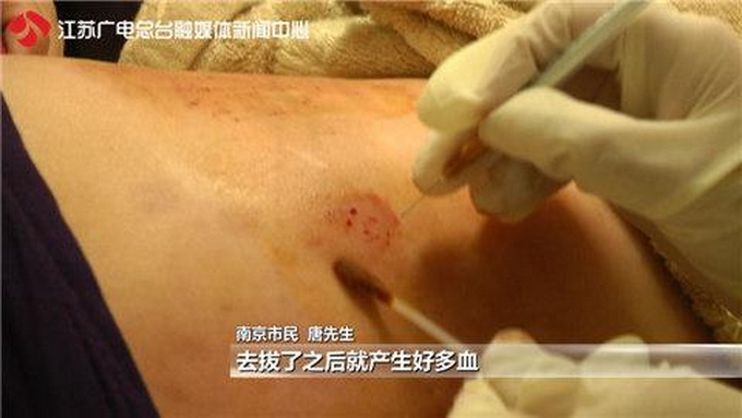 放血排毒疼到报警 “穴位”上被扎二十多针立刻血流如注