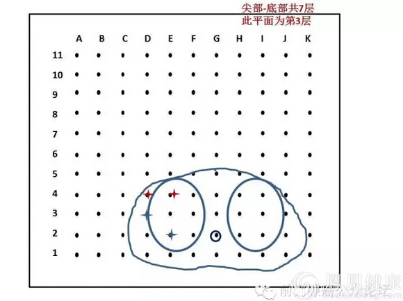 精准医疗在泌尿外科的应用---前列腺癌精准穿刺活检