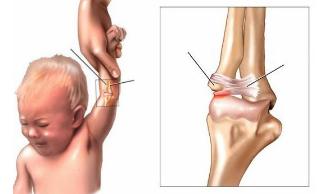 如何预防小孩手臂脱臼