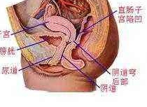 盆腔炎怎么治疗最佳