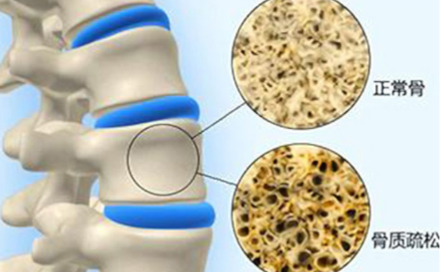 什么引起骨质疏松