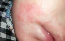 儿童湿疹预防护理