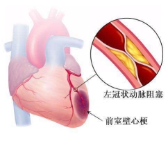 心脏病心绞痛吃什么药