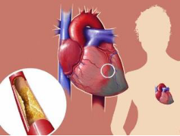 心肌梗死术后注意事项有哪些