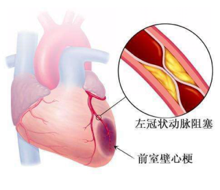 急性心肌梗死溶栓后的护理措施有哪些