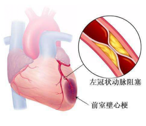 心肌梗死护理诊断有哪些