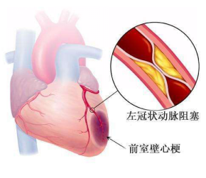 心肌梗死治疗后的注意事项有哪些