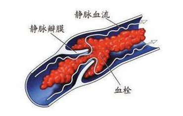 深静脉血栓怎么治疗