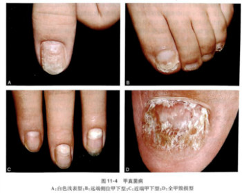 指甲厚是灰指甲吗？灰指甲有什么症状？
