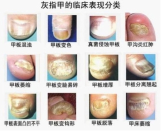 亮甲产品的优势有哪些？科学、专业、贴心