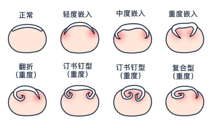 灰指甲与甲沟炎怎么鉴别？方法在这里