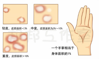 银屑病具有哪些病理特征？记准了好分辨