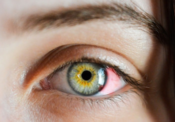 眼痒难耐！过敏性结膜炎用什么眼药水缓解好？