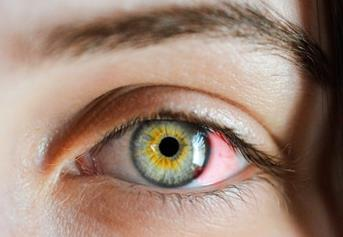 眼结膜炎的症状及治疗方法有哪些？三种常见结膜炎介绍