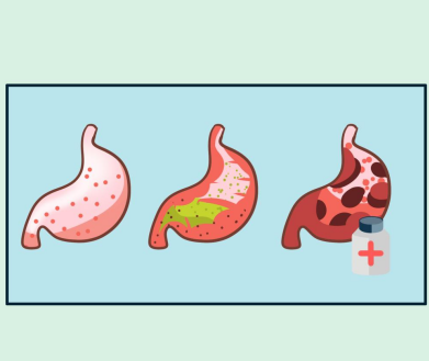 胃酸过多吃奥美拉唑肠溶胶囊有用吗？