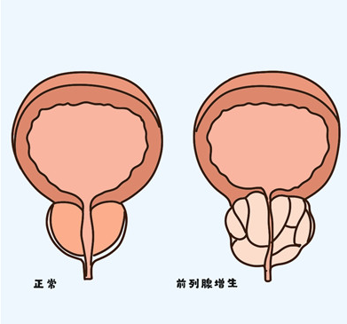 前列腺增生能同时口服非那雄胺片和坦洛新吗？两者搭配，效果加倍！