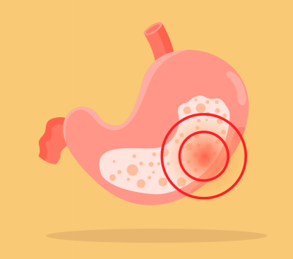 急性肠胃炎腹泻吃什么药效果好？早知早受益