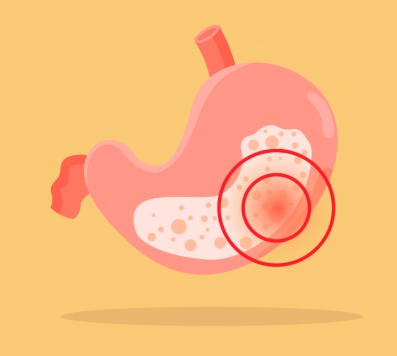 慢性胃炎能引起腹泻腹疼吗？伤胃的事儿别再干了！